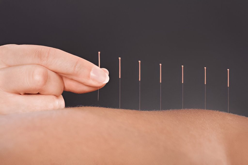 Acupuncture Work